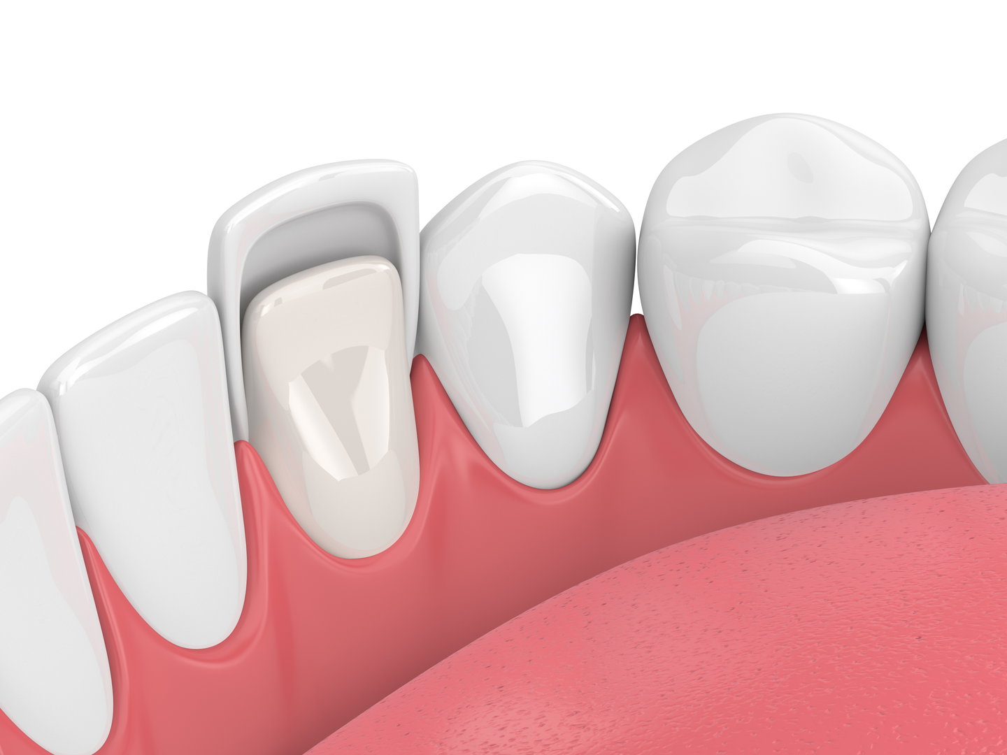 dental-bonding4