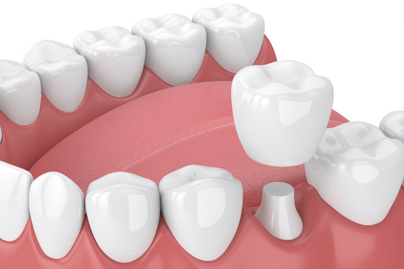 Dental Crowns in Bear